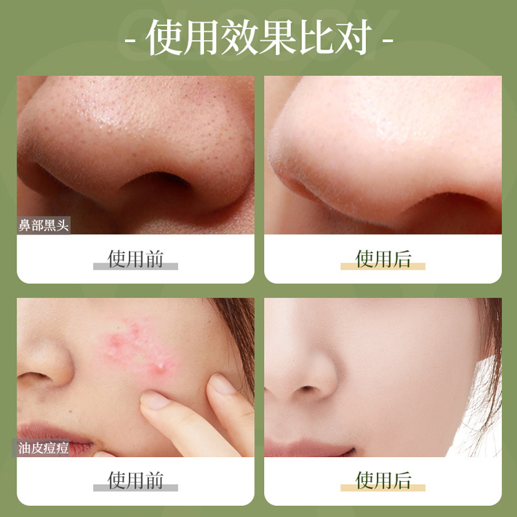 祛黑頭美白泥膜