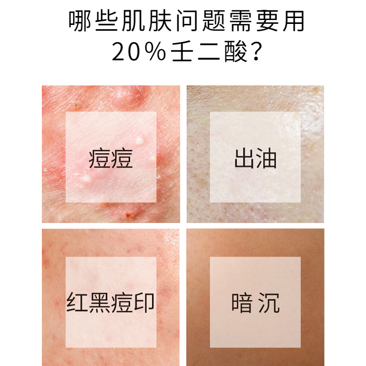 壬二酸祛痘霜